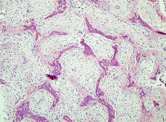 Myofibroma | definition of myofibroma by Medical dictionary