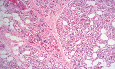 capillary hemangioma in adults #10