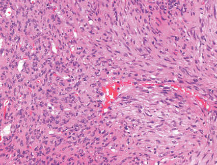 Infantile Myofibromatosis - NORD (National Organization ...