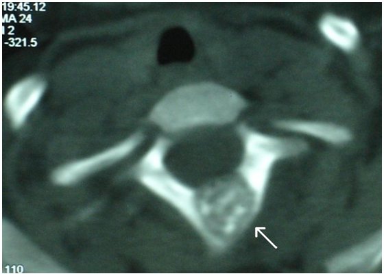 aneurysmal bone cyst mandible. PRIMARY BONE CYSTS